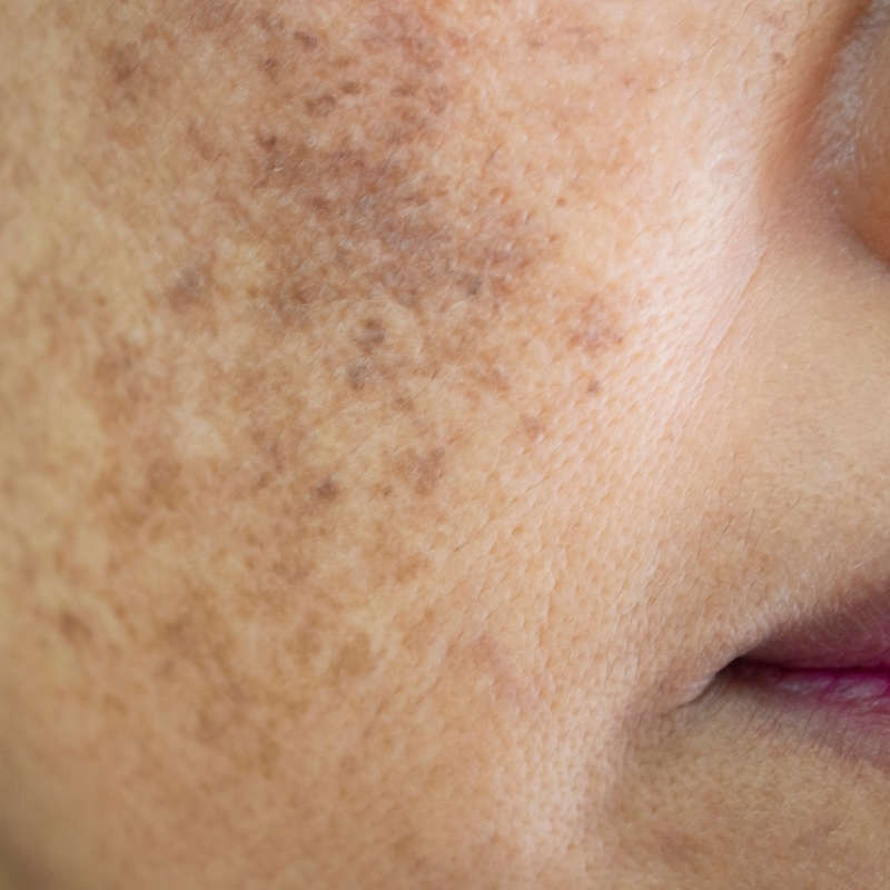 Sun Damage, Brown Spots & Hyperpigmentation